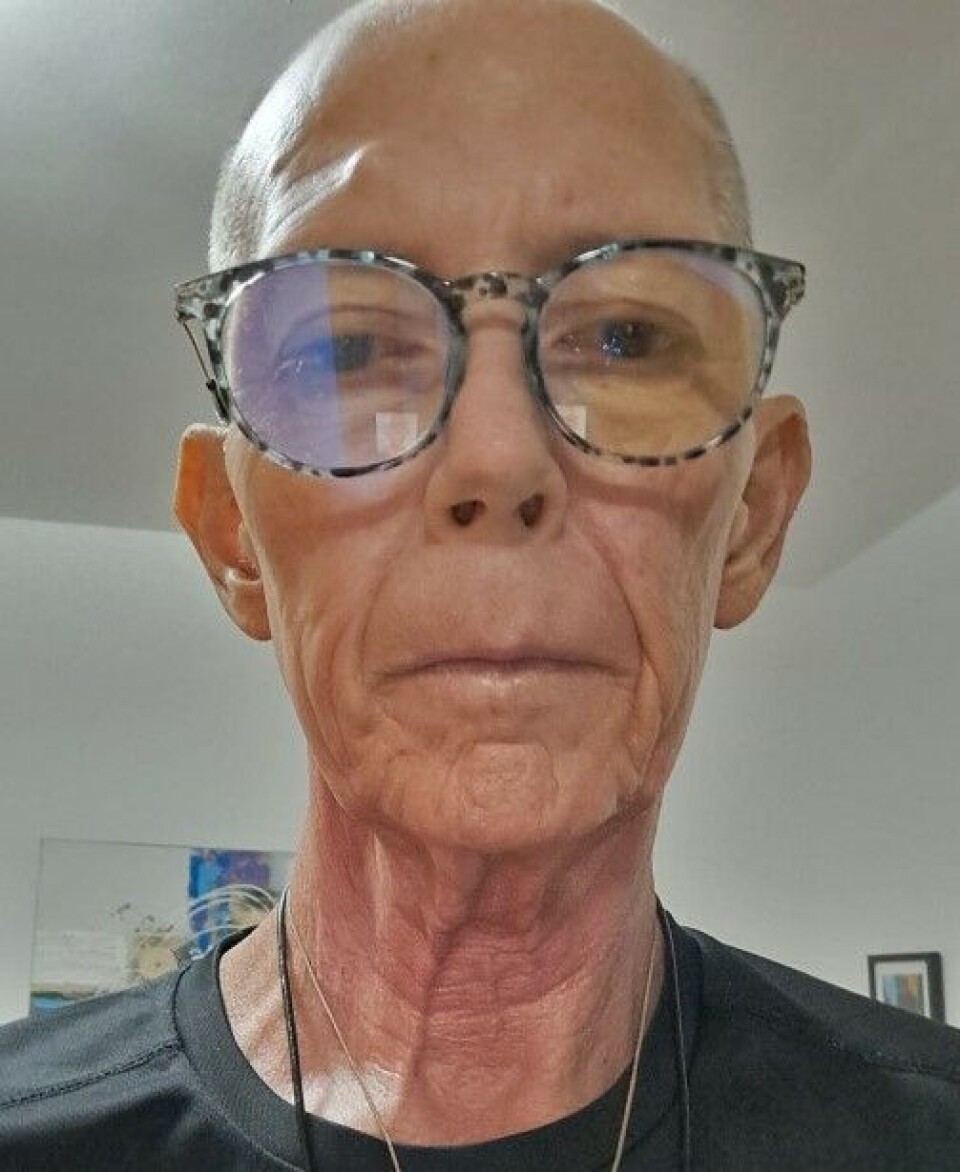 Iver delte de første sjokkbildene og nyheten om at han hadde fått kreft på Facebook. Da hadde han gått ned fra 125 kilo til under 60. Foto: Privat Iver delte de første sjokkbildene og nyheten om at han hadde fått kreft på Facebook. Da hadde han gått ned fra 125 kilo til under 60. Foto: Privat